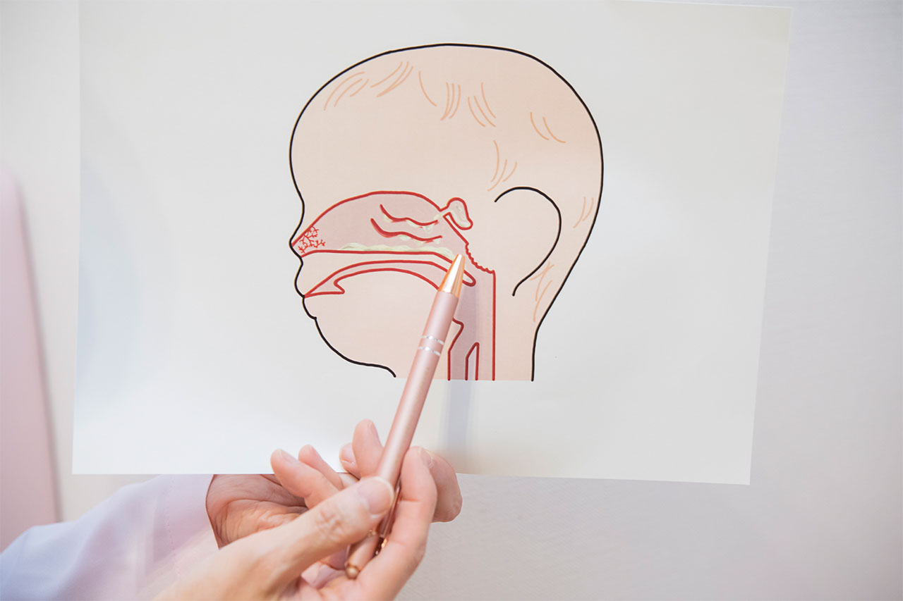 頭部の断面イラストの、副鼻腔内の鼻水をペンで指さしています。